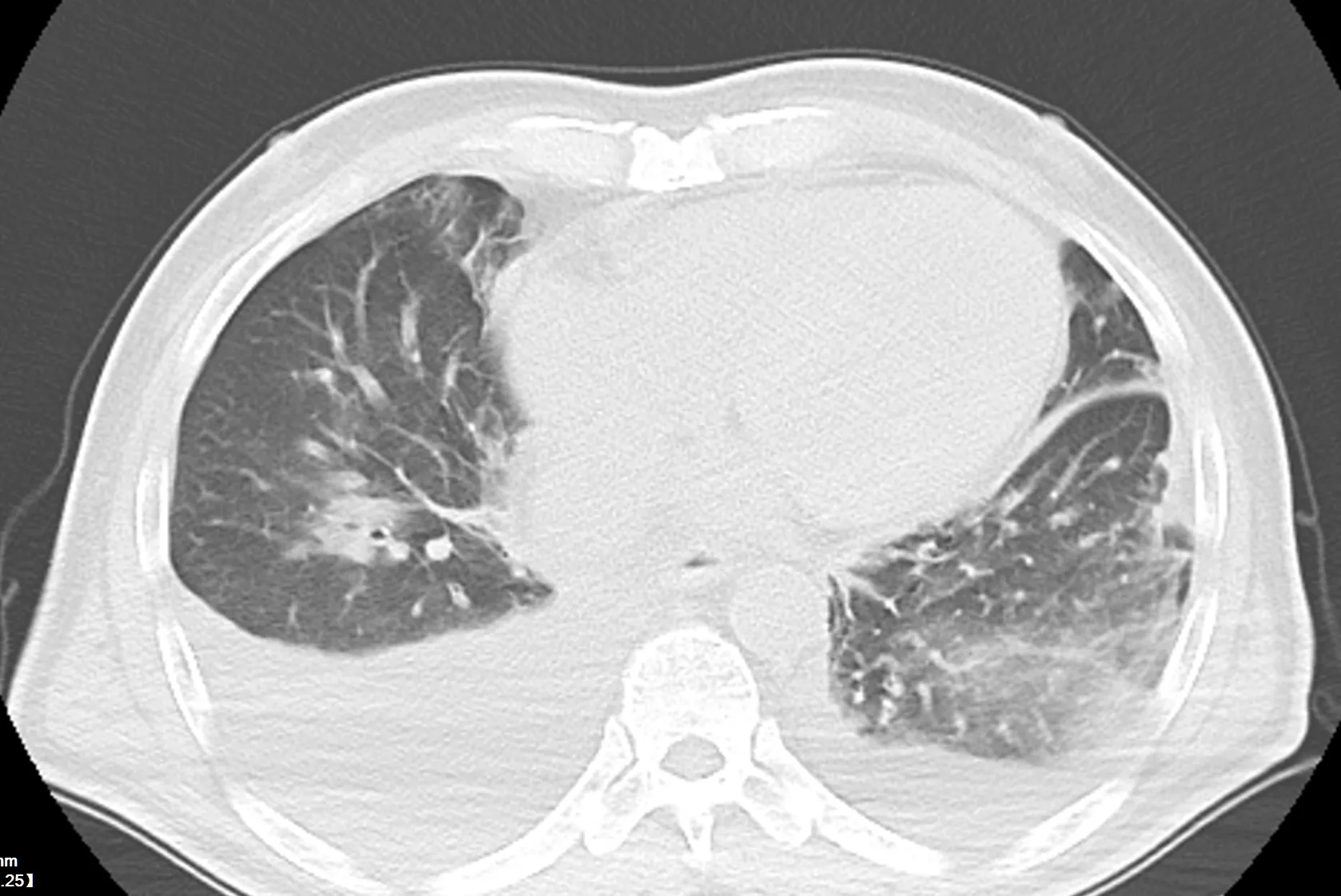 10:补液补多了,肺水肿啦!
