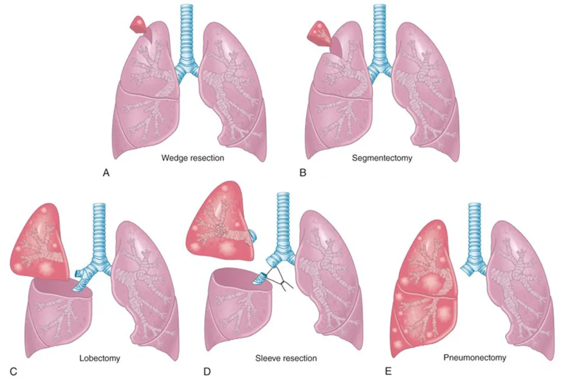 11:楔切、段切、叶切、袖式、全肺切除