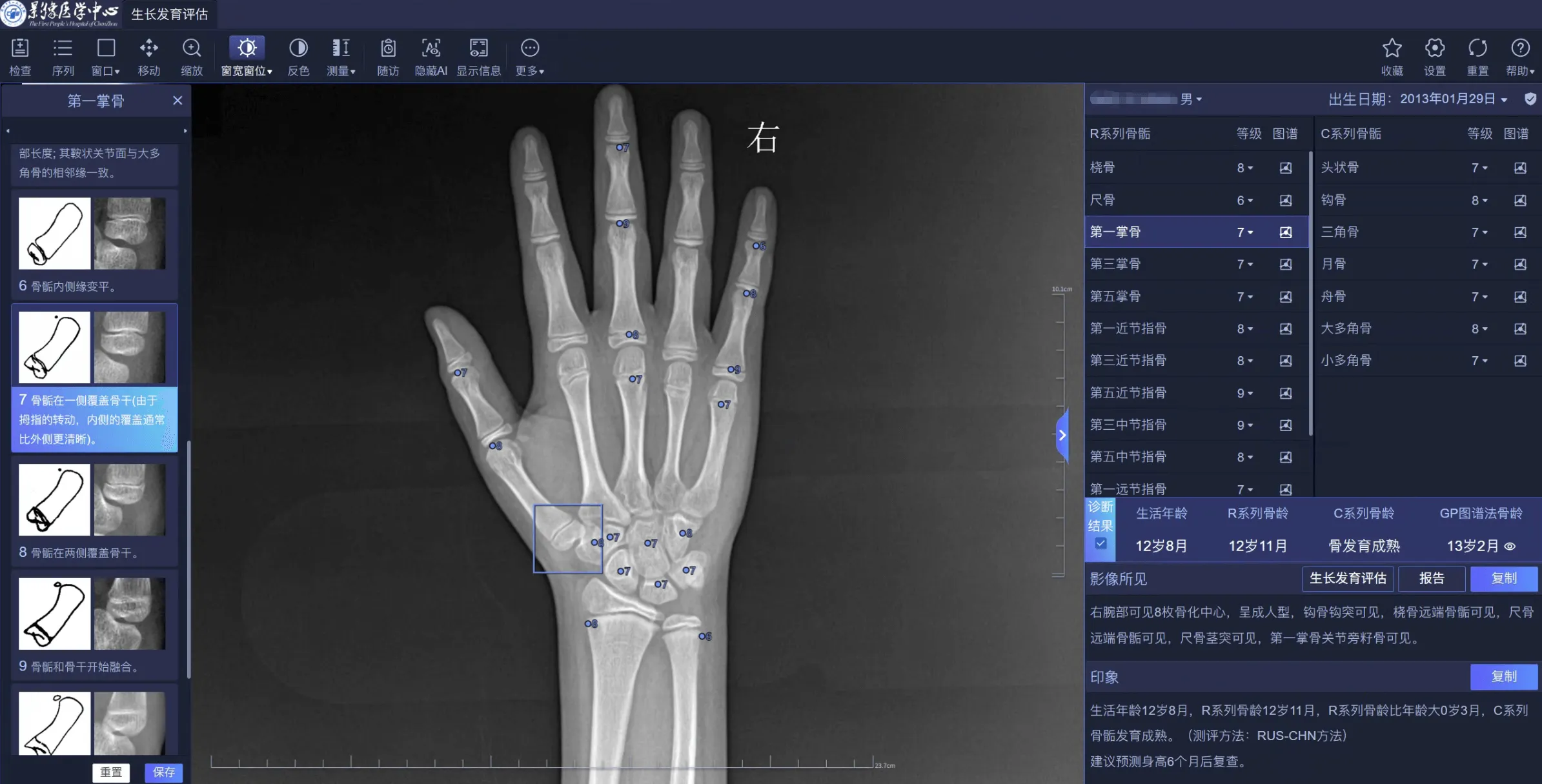 11：AI骨龄方案